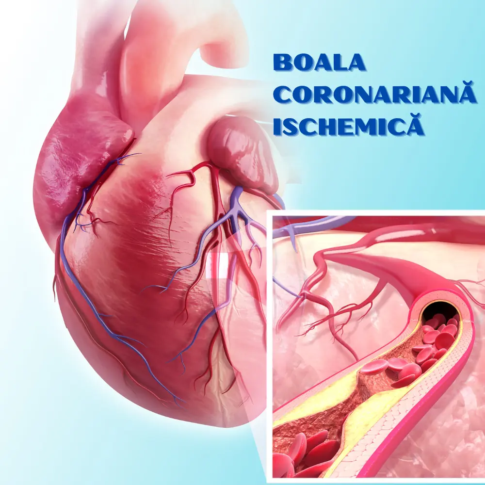 boala-coronariana-ischemica.png